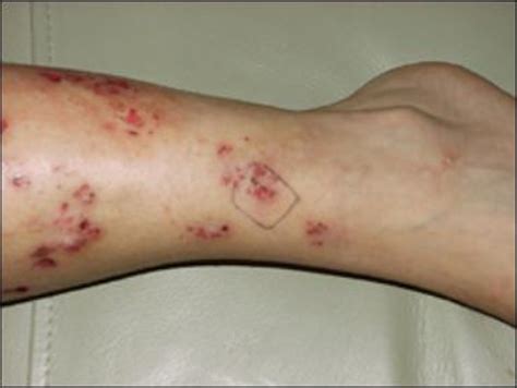 Morgellons Disease Pictures and Story | TimeSocket