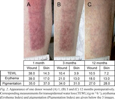 Figure 2 from Erythema persists longer than one year in split-thickness ...