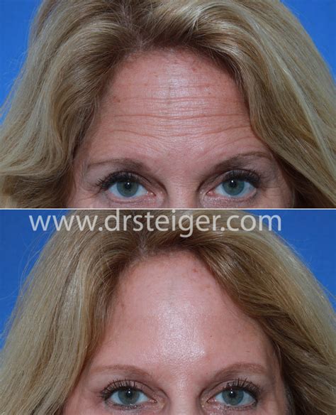 Xeomin Before and After Photos Boca Raton