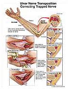 Ulnar nerve Transposition Correcting Trapped Nerve Medivisuals