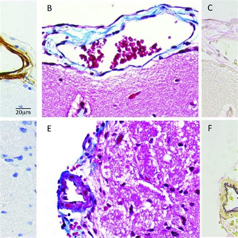 Immunohistochemical staining for Aβ of leptomeninges, leptomeningeal ...