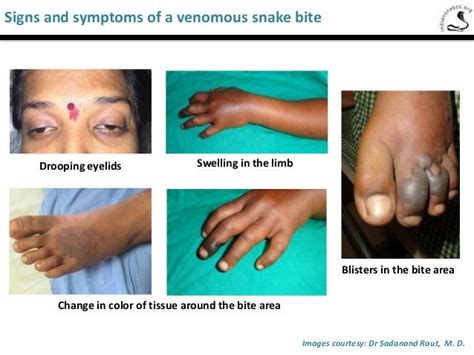 Snake Bite! - Firstaid, Facts & Prevention