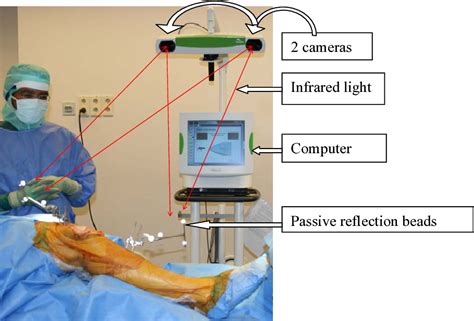 Navigation-guided Knee Replacement — Doctor Pal