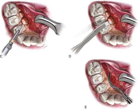 Torus Mandibularis Removal