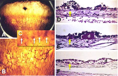 Reticular degeneration of the retinal pigment epithelium (RDPE). Panels ...