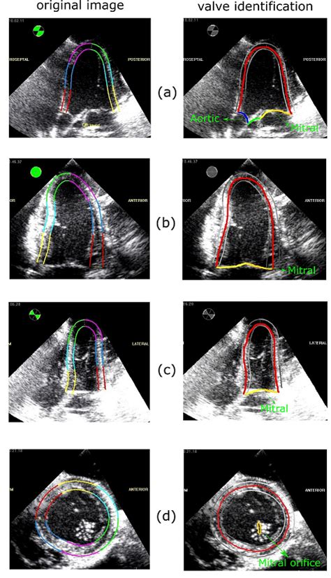 View of heart valves from different planes of 2D-echo at the beginning ...