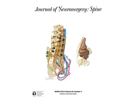 Innovative False Pedicle Surgery Allows for Advanced Spinal/Pelvic ...