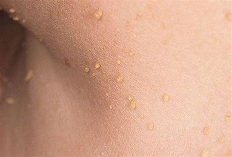 27 best Moles, Warts And Skin Tags images on Pinterest | Health, Home remedies and Skin problems