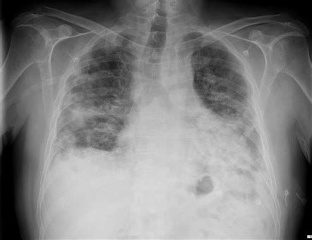 Cryptogenic organizing pneumonia | Radiology Case | Radiopaedia.org