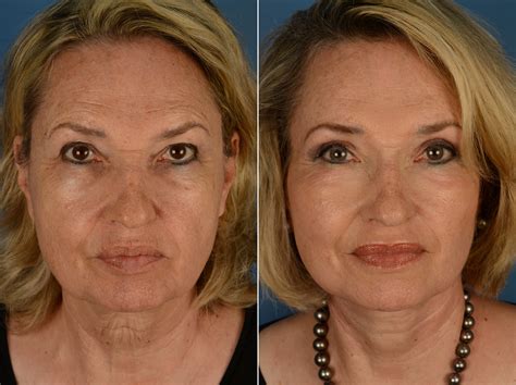 Eyebrow & Forehead, The UpLift™ Lower Face and Neck Lift Photos | Naples, FL | Patient 13203