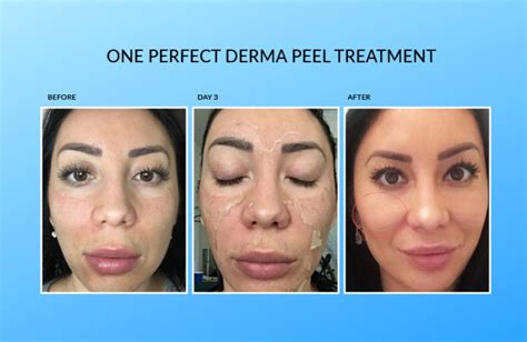 The Perfect Derma™ Peel | Advanced Skin & Body Solutions