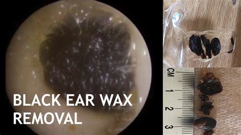 BLACK EAR WAX REMOVAL - #437 - YouTube