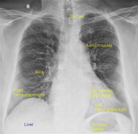 X-ray Chest PA View (CXR-PA) – All About Cardiovascular System and Disorders