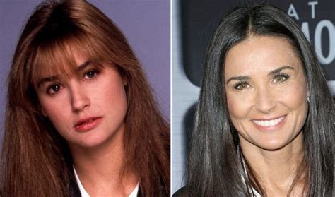 Demi Moore before and after plastic surgery