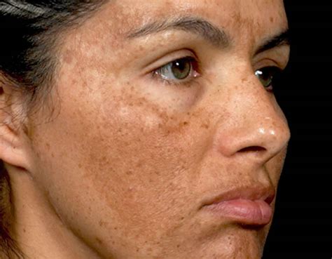 Melasma causes, symptoms, diagnosis & best treatment for melasma on face