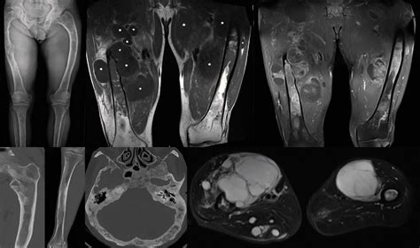 Radiomic features for patients with primary soft tissue sarcomas: A prognostic study - synbrAIn ...