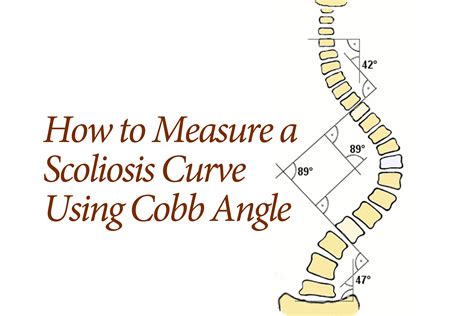 How Scoliosis Is Measured by the Cobb Angle