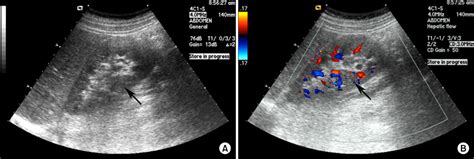 Diagnosing Acute Pyelonephritis with CT, 99mTc-DMSA SPECT, and Doppler ...