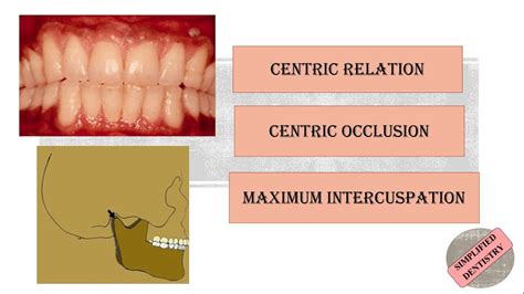 Centric Relation | Centric Occlusion | Maximum Intercuspation - YouTube