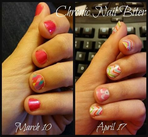 Before and After nail biter. #beforeandafter #nailbiter #nailcare #healthynails #nails #nailart ...