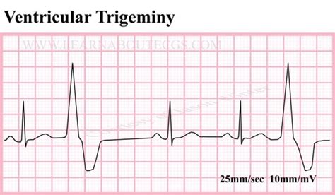 Items similar to Ventricular Trigeminy ECG Strip on Etsy