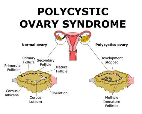 How To Get Periods For Pcos