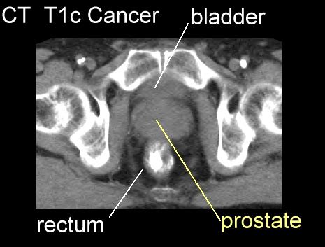 Prostate Imaging