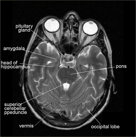 The Radiology Assistant : Brain Anatomy