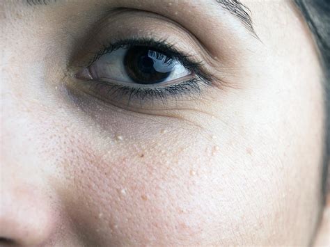 Milia under eyes: Causes, diagnosis, and treatment