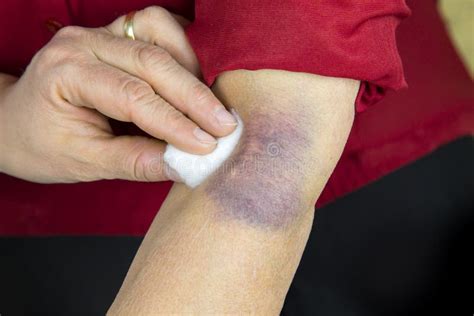 Large bruise on human arm stock photo. Image of medical - 52499210