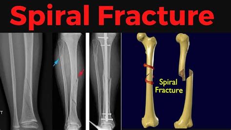 Spiral fracture - MEDizzy