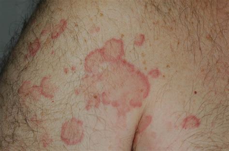 Urticarial Vasculitis - Types, Causes, Symptoms, Treatment