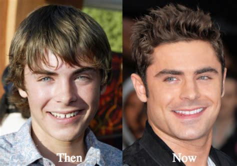 Zac Efron Plastic Surgery Before and After Photos