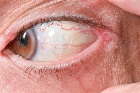 Conjunctival retention cysts - Stock Image - C042/6382 - Science Photo Library