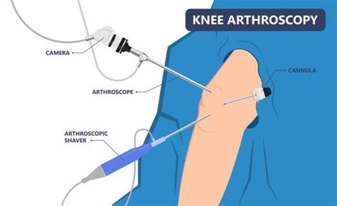 Arthroscopy Keyhole Surgery - Oxford Ortophaedics Clinic