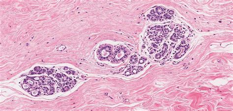 Stroma - Pathology dictionary - MyPathologyReport.ca