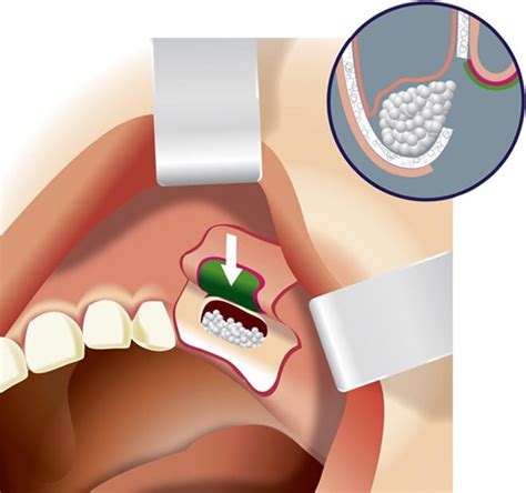 Sinus Lift Singapore | Sinus Augmentation | Cost of Sinus Lift Surgery