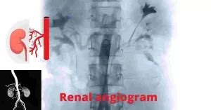 Renal angiogram in Hyderabad: Cost, Procedure and Complications - CARDIOLOGIST HYDERABAD