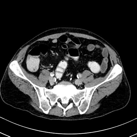 File:Chronic appendicitis complicated by appendicular abscess, pylephlebitis and liver abscess ...