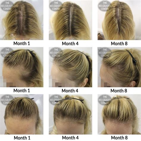 What Causes Women s Hair To Thin The Ultimate Guide - Best Simple Hairstyles for Every Occasion