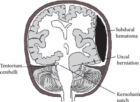 [PDF] Kernohan's Notch: A Forgotten Cause of Hemiplegia—CT Scans Are Useful in This Diagnosis ...