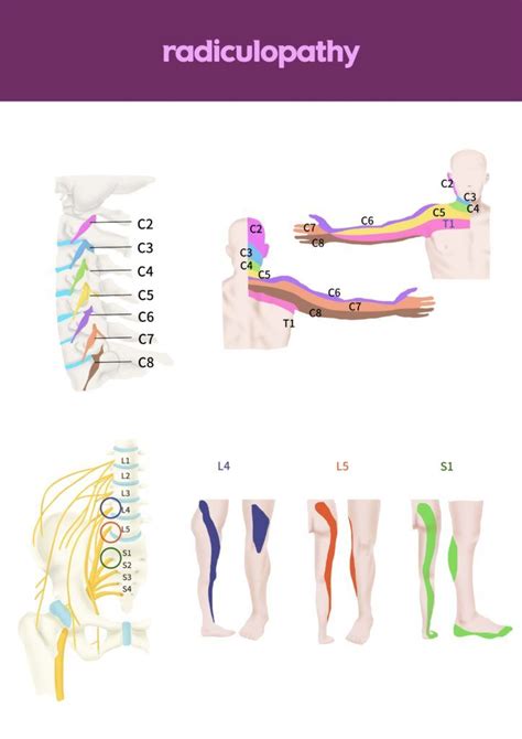 What is Radiculopathy? - Premier Neurology & Wellness Center