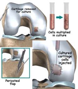 Articular Cartilage Transplant | Knee Doctor near Seattle WA