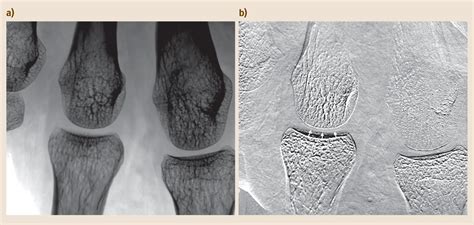 Biomedical X-Ray Phase-Contrast Imaging and Tomography | SpringerLink