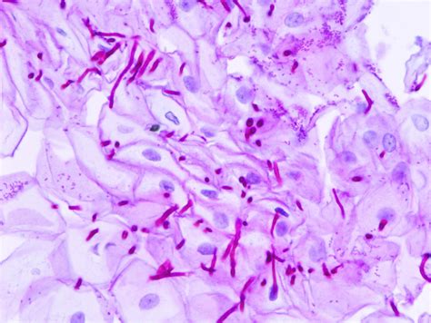 Opportunistic Mycoses - USMLE Strike