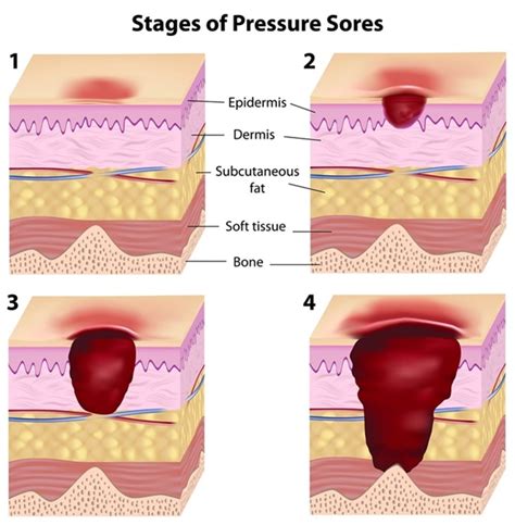 Stage 1 Pressure Ulcer