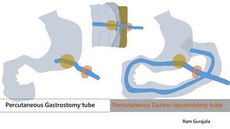 Percutaneous Gastrostomy/Gastro-Jejunostomy tube placement | IR 4 U