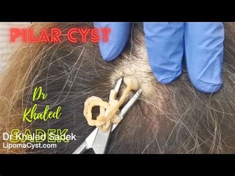 Pilar Cyst Removal. London.Dr Khaled Sadek. LipomaCyst.com - YouTube ...