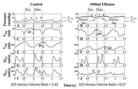 Right Heart Hemodynamics. Right heart hemodynamic waveforms for the ...