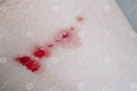 Bleeding Wound on the Skin, Caucasians Stock Photo - Image of painful ...